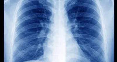 Mezotelyoma nedir? nasıl tedavi edilir?