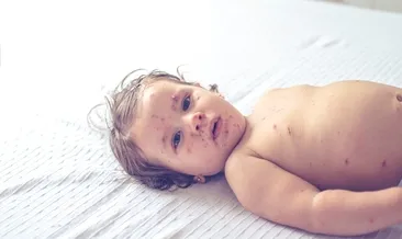 Kızamık aşısı yapılmazsa ne olur?