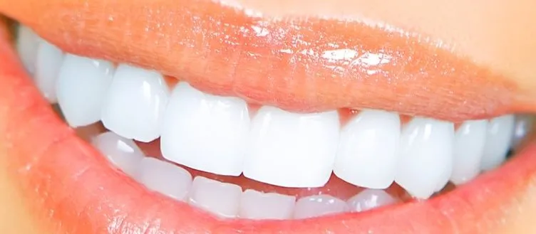 Diş nasıl beyazlatılır?