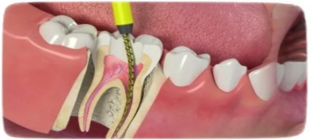 Dikkat Uzmanlar Uyariyor Cektirmeyin Kanal Tedavisi Yaptirin Son Dakika Haberler