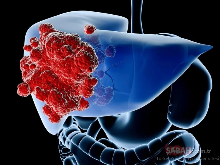 Karaciğer kanseri belirtileri nelerdir? İşte karaciğer kanserine neden olan etkenler...