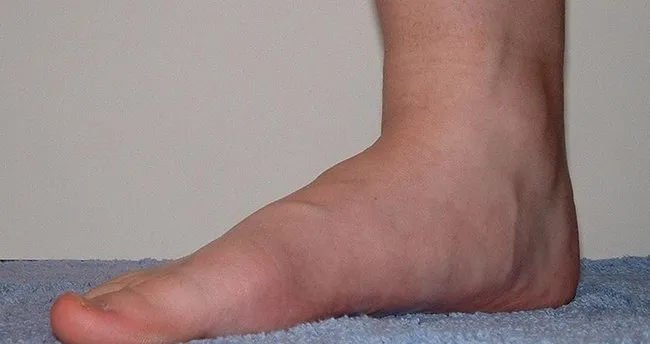 Duz Taban Nedir Duz Tabanlik Nasil Anlasilir Son Dakika Haberler