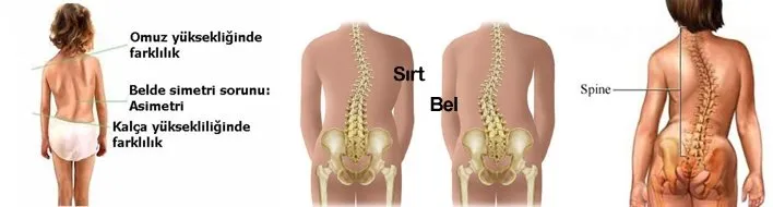 Cocuklarda Skolyoz A Diger Adiyla Omurga Egriligine Dikkat Saglik Haberlerison Dakika Haberler
