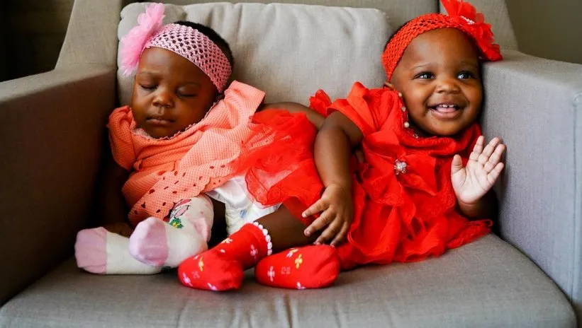 Kamerun’dan Türkiye’ye mucize operasyon! Yapışık siyam ikizleri ayrıldı