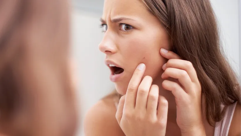 AKNE VE SİYAH NOKTA TEDAVİSİNDE DİKKAT