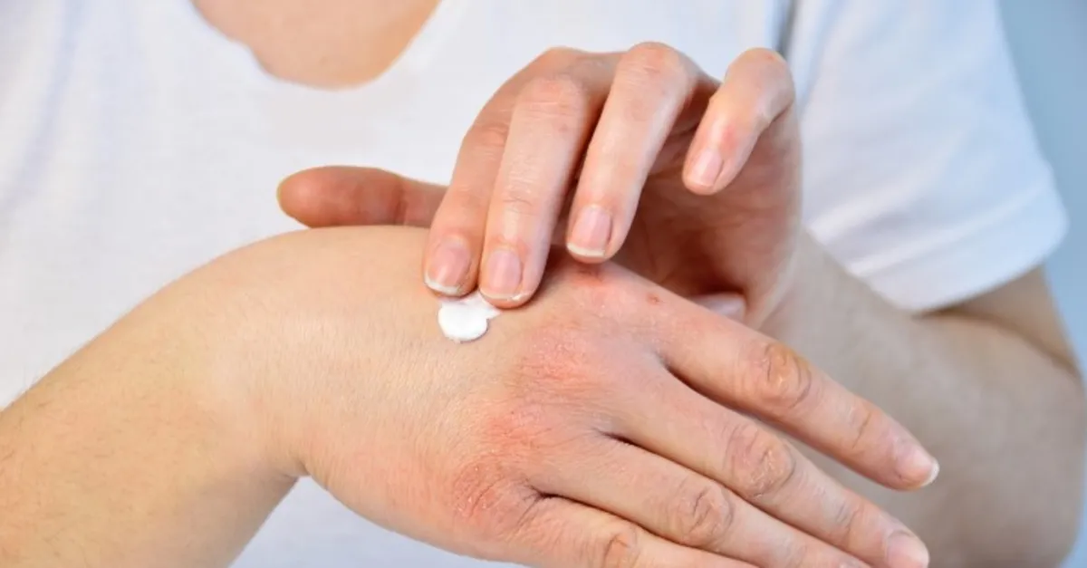 El ve dudak çatlatan soğuklara dikkat!