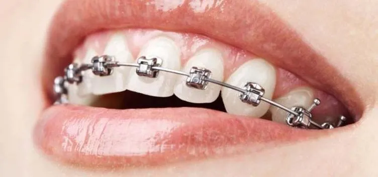 Diş teli tedavisinde doğru bilinen 7 yanlış