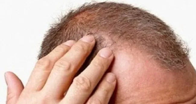 Saçkıran nedir? Nasıl tedavi edilir?