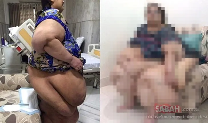 Tuvalete bile gidemiyordu… 2 senede 175 kilo verdi