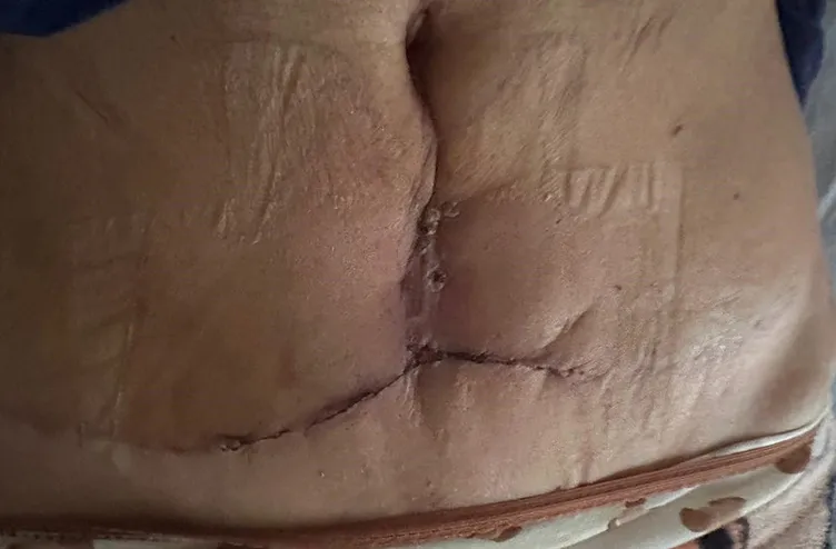 Kol ve karın germe ameliyatı hayatını kabusa çevirdi: Operasyondan tam 1 yıl sonra…