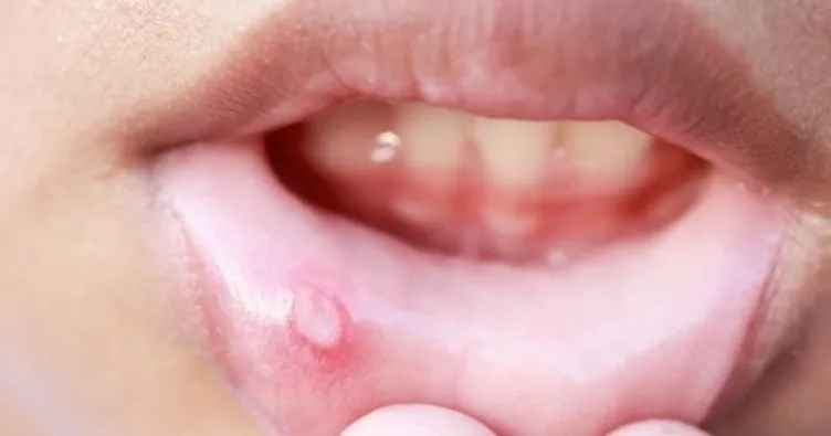 Ağız içi yaraları nasıl geçer?