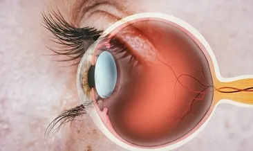 Retina Yırtılması Belirtileri Ve Tedavisi - Retina Dekolmanı Ve Yırtılması Nasıl Tedavi Edilir, İyileşir Mi?