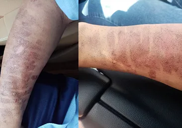 Lazer epilasyon yaptırdı, kolları yandı