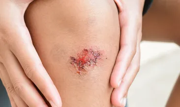 Rüyada yaralanma görmek ne anlama gelir?