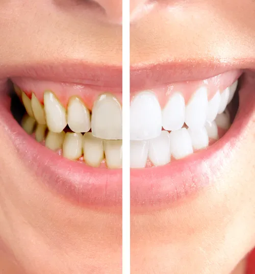 Dişlerinizi karbon tozuyla bir hafta fırçalarsanız