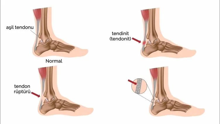 AŞİL TENDONU NEDİR? Aşil nerede, neden kopar? Aşil tendonu kopması / yırtılması nasıl olur, iyileşir mi, tedavisi ne kadar sürer?