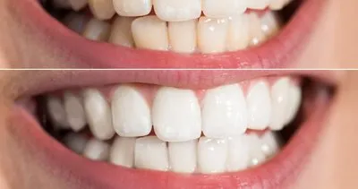Sadece yedi günde beyaz dişlere ulaşmanın sırrı!