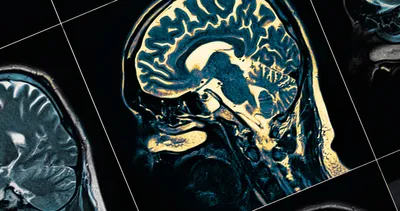 Bilim insanlarından korkutan açıklama! Bu vitaminin eksikliği beyni köreltiyor, bunamaya neden oluyor