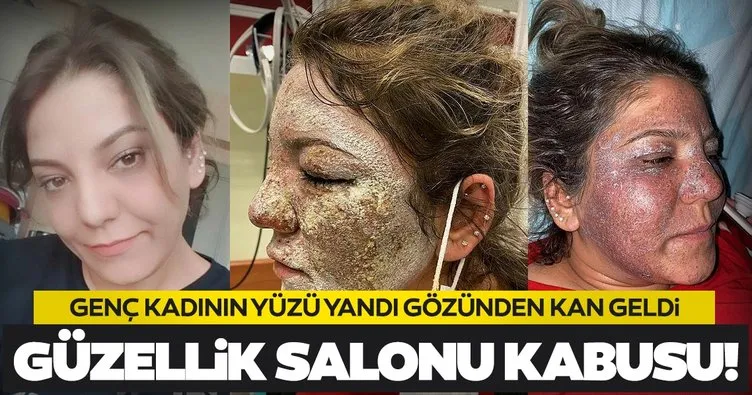 Son dakika: Güzellik salonu kabusu! Yüzü yandı gözünden kan geldi