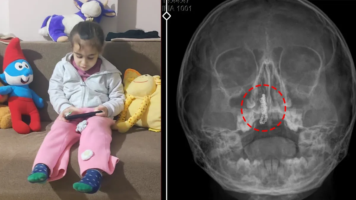 SON DAKİKA… Şiddetli kanama ve akıntı şikayetiyle gitti! Doktorlar bile şoka girdi: 5 yaşındaki Polen’in burnundan bakın ne çıktı! SON DAKİKA… Şiddetli kanama ve akıntı şikayetiyle gitti! Doktorlar bile şoka girdi: 5 yaşındaki Polen’in burnundan bakın ne çıktı!