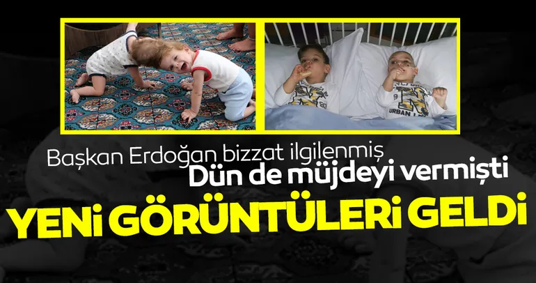 Başkan Erdoğan’ın bizzat ilgilendiği siyam ikizleri yarın geliyor; İşte son halleri