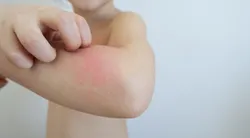 Egzaması olan çocuklar için altın değerinde bakım önerileri