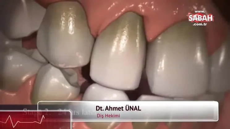 Diş taşı nasıl temizlenir? Diş taşı temizliği yöntemleri | Video