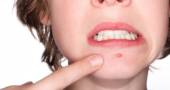 1 gecede sivilce yok etme ve kurutma