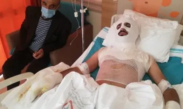 Isınmak için tenekeye tiner atınca elinde ve yüzünde yanıklar oluştu #erzincan