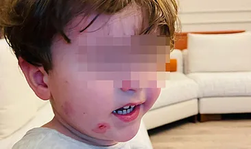 Kreşe bıraktığı çocuğunu darp edilmiş olarak geri aldı! #bursa