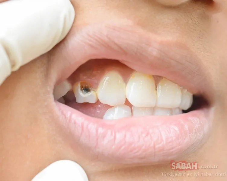 Çürük diş problemi olanlar dikkat! Bu besin çürük diş problemini ortadan kaldırıyor
