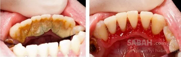 dis taslarinizi dogal yontemlerle yok