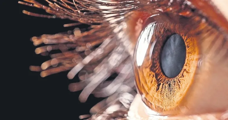 Göz içi tümörüne radyoaktif plak tedavisi