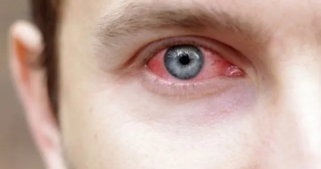 gozlerde sulanma isiga hassasiyet varsa dikkat saglik haberleri