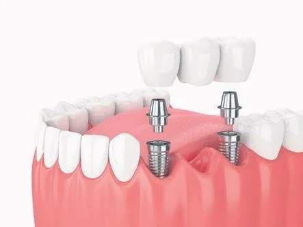 sorunsuz implant yaptirmak icin yeni