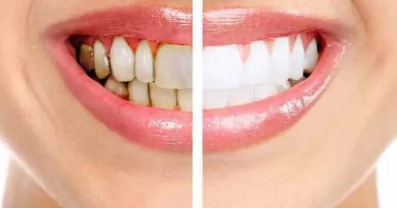 Dislerin Sararmasinda En Buyuk Etken Cay Ve Kahve Saglik Haberleri