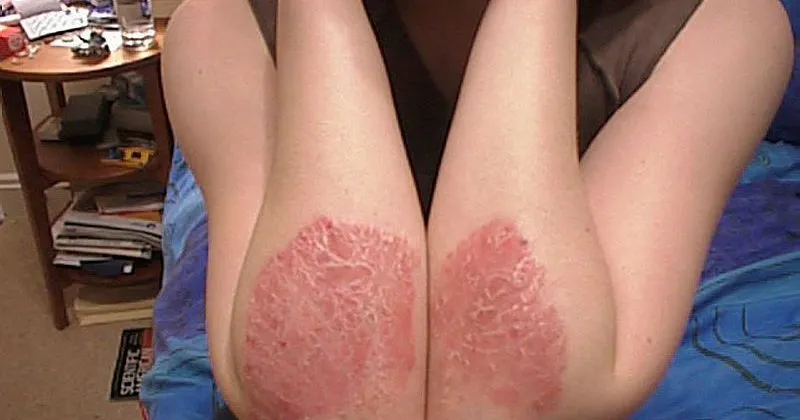 Sedef Hastaligi Nedir Sedef Hastaligi Tedavisi Nasil Yapilir Son Dakika Haberler