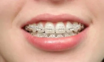 Diş telleri hakkında bilinmesi gerekenler nelerdir? Diş telleri nasıl takılır?