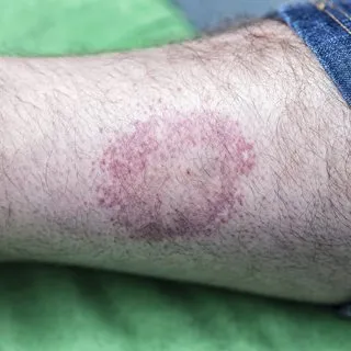 Lyme hastalığı nedir, belirtileri nelerdir? Lyme hastalığı neden olur?