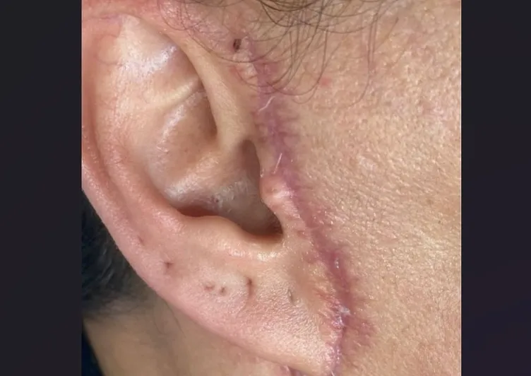 SON DAKİKA | Estetik ameliyatı genç kadının kabusu oldu: Kulağını kesip yüzünü diktiler