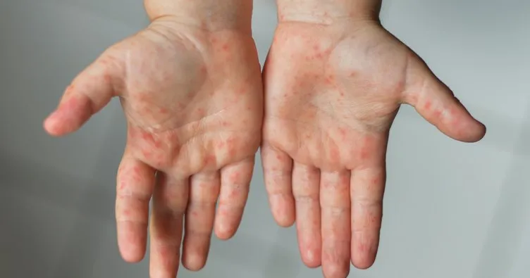 Cocuklarda El Ayak Ve Agiz Hastaligina Dikkat Cocuk Haberleri