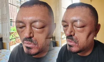 SON DAKİKA... Saçlarını siyahlaştırmak isterken az kalsın kör oluyordu: İnternetten aldığı şampuan bu hale getirdi! #adana