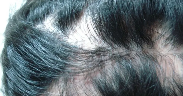 Saçkıran için doğal ve bitkisel tedavi yöntemleri! Saçkırana ne iyi gelir, neden olur ve nasıl tedavi edilir?