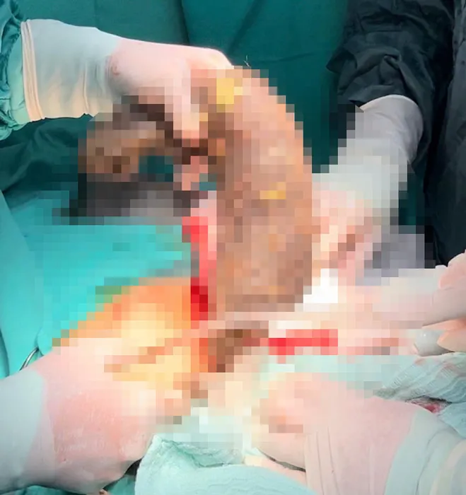 Doktorlar bile şaşkın: Midesinden 50 santim saç yumağı çıktı!