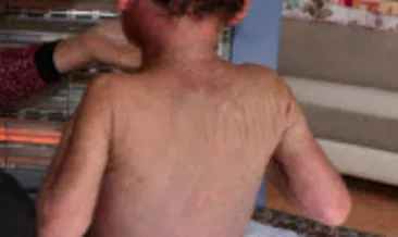 Hiperimmunglobulin sendromu nedir?