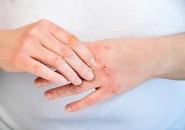 Çatlamış ve kurumuş elleri anında yumuşatıyor! Bu iki malzemeyi eksik etmeyin