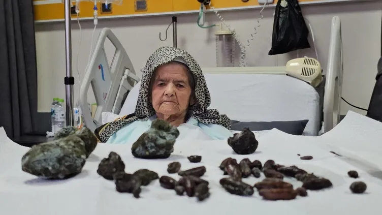 Doktorlar şoke oldu: 92 yaşındaki kadının midesinden ve bağırsaklarından neler çıktı neler!