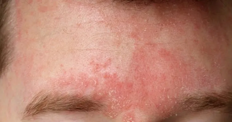 egzamaya ne iyi gelir egzama nedir