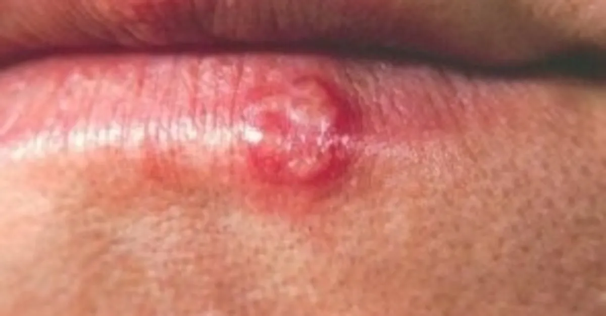 frengi nedir belirtileri ve tedavi