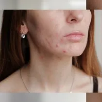 sirtta sivilce neden cikar sirttaki